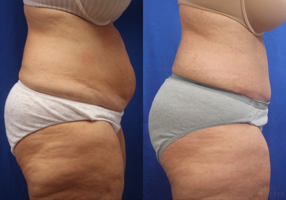 Tummy Tuck - Thumbnail 2