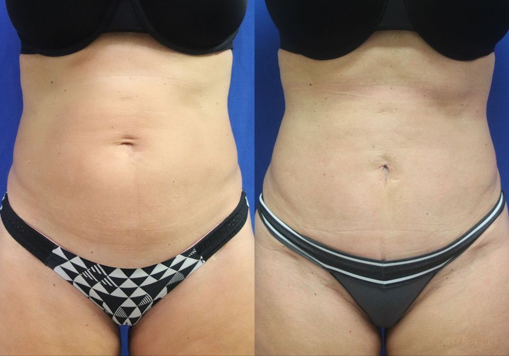 Before and after procedure result