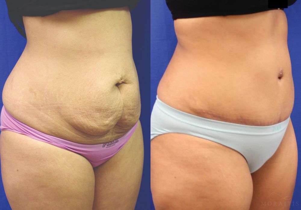 Tummy Tuck - Thumbnail 2