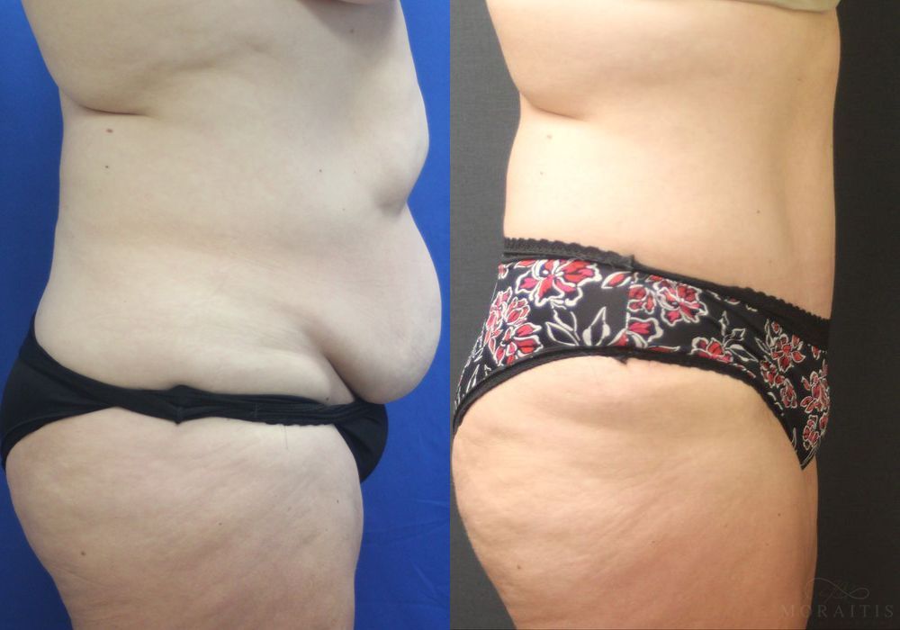 Tummy Tuck - Thumbnail 3