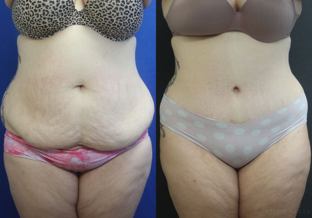 Tummy Tuck - Case 15367