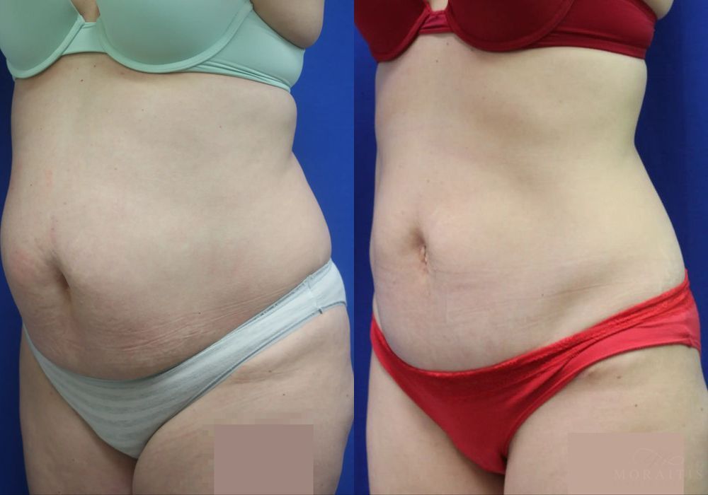 Tummy Tuck - Thumbnail 2