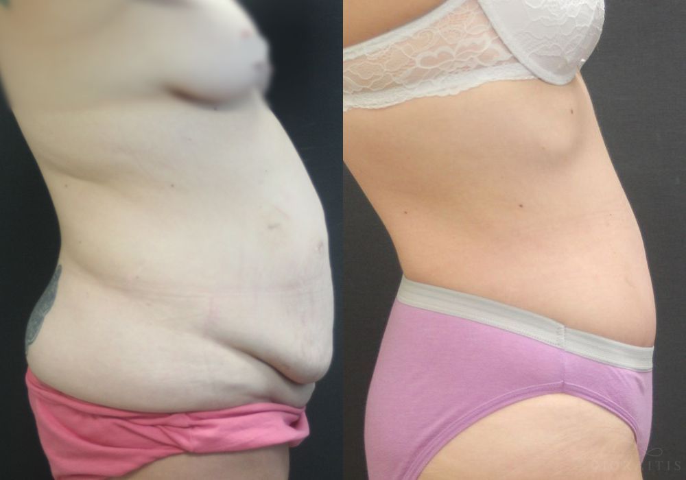 Tummy Tuck - Thumbnail 3