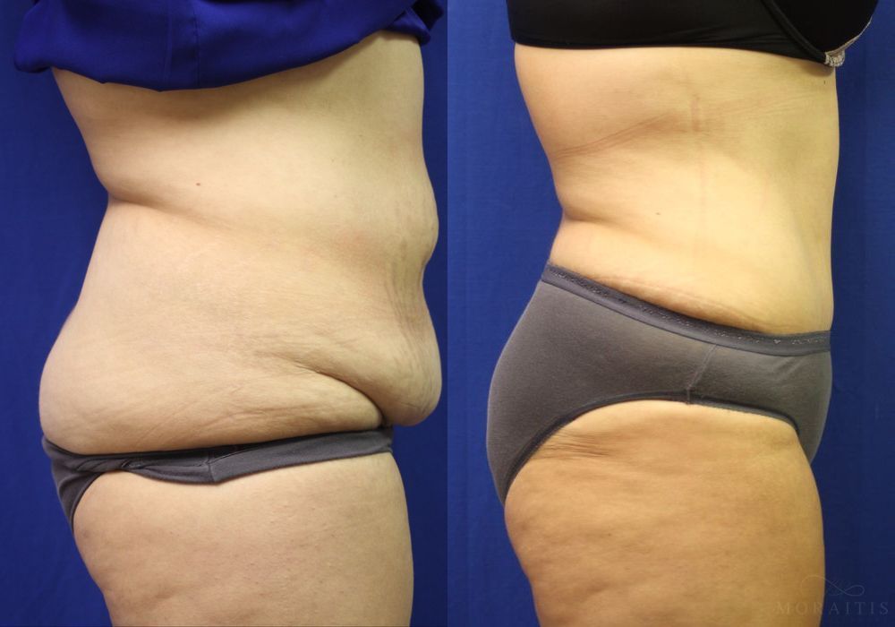 Tummy Tuck - Thumbnail 2