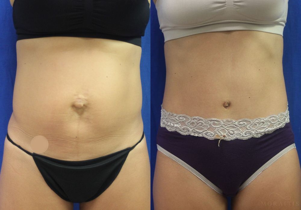 Tummy Tuck - Case 15350