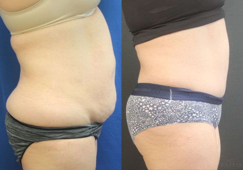 Tummy Tuck - Thumbnail 3