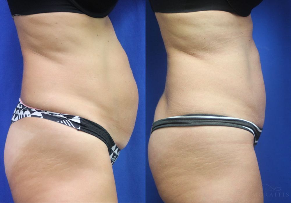 Tummy Tuck - Thumbnail 3