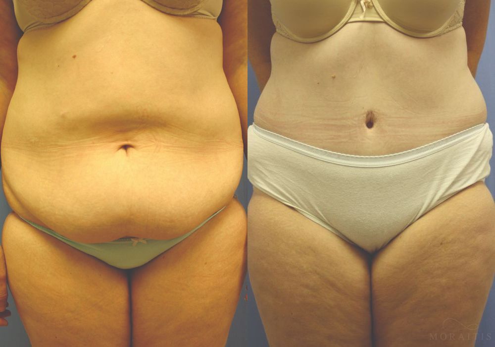 Tummy Tuck - Case 15354