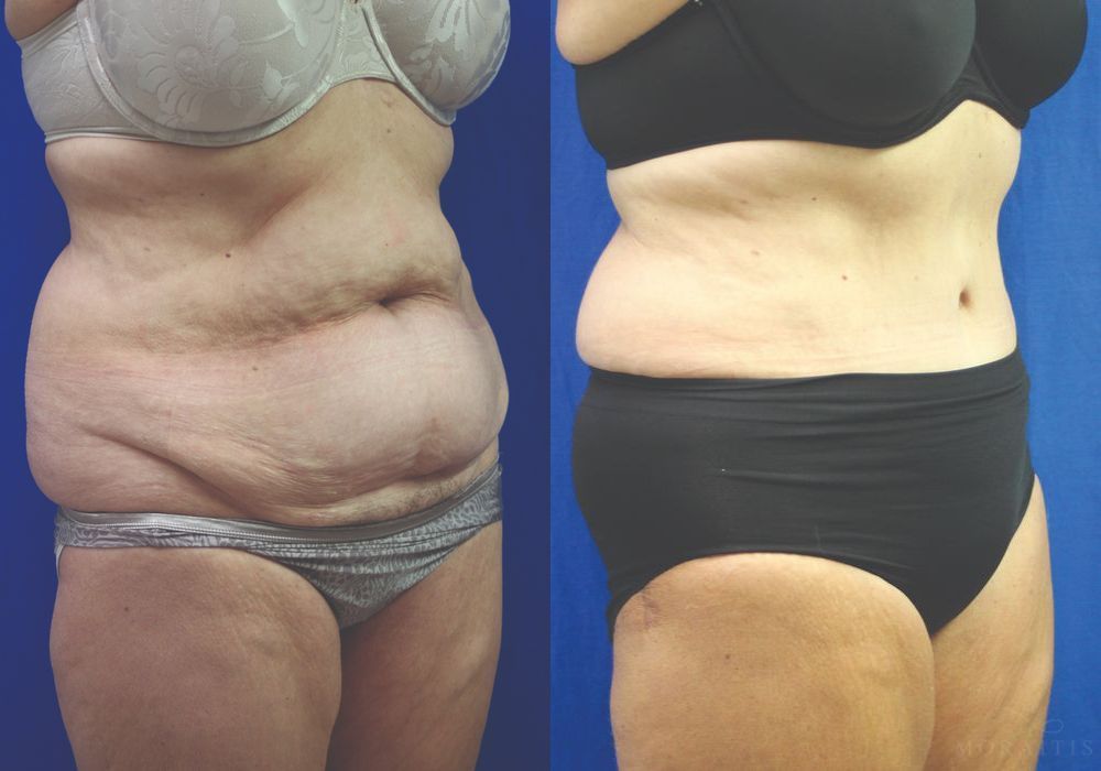 Tummy Tuck - Thumbnail 2
