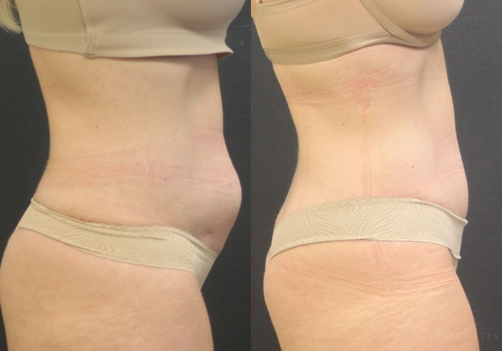 Tummy Tuck - Thumbnail 3