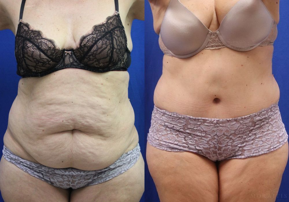 Tummy Tuck - Case 15341
