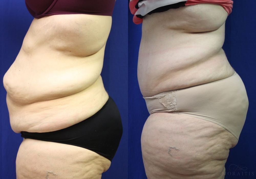 Tummy Tuck - Thumbnail 2
