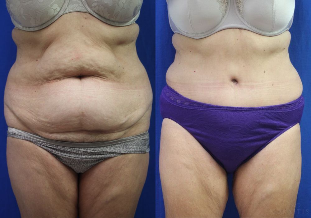 Tummy Tuck - Case 15349