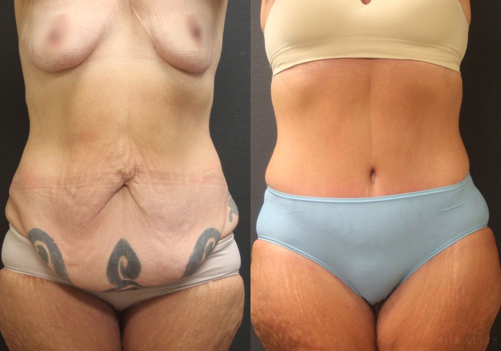 Tummy Tuck - Case 15340