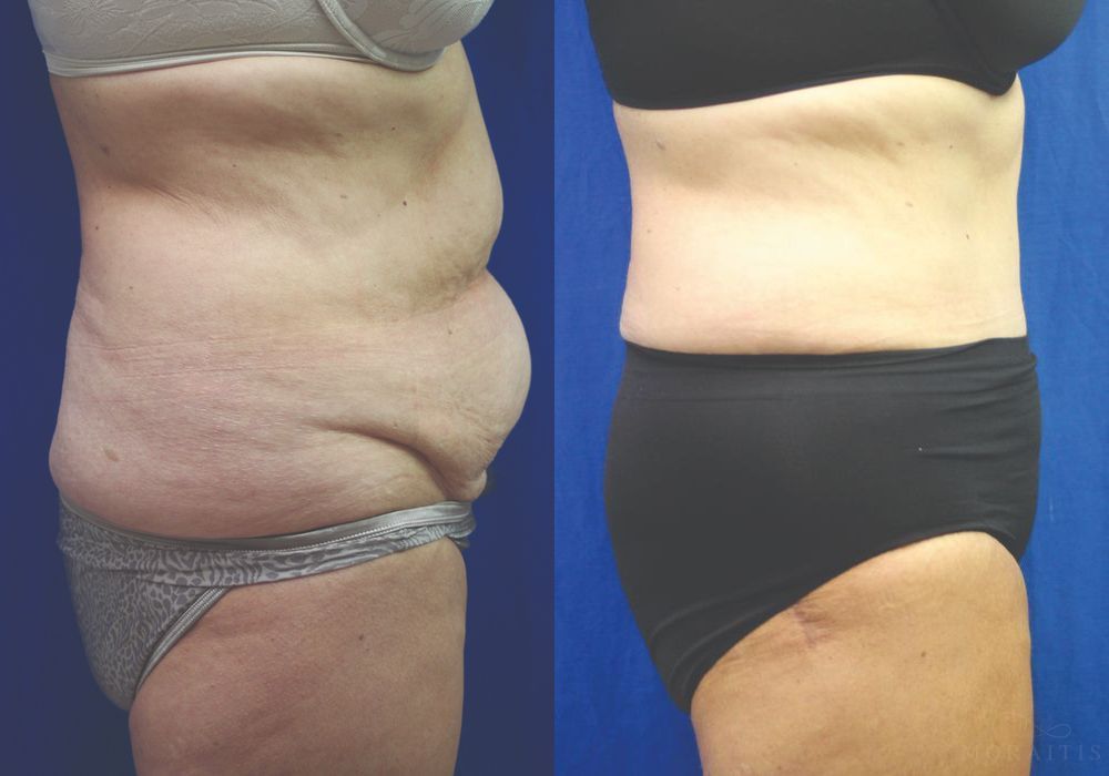 Tummy Tuck - Thumbnail 3