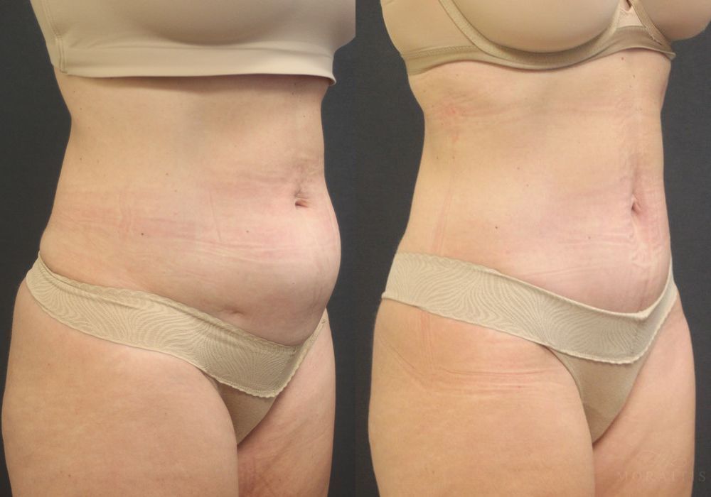 Tummy Tuck - Thumbnail 2