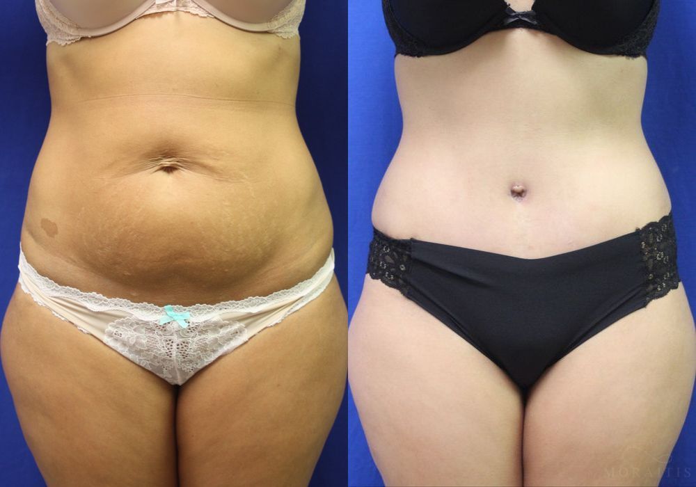 Tummy Tuck - Case 15345