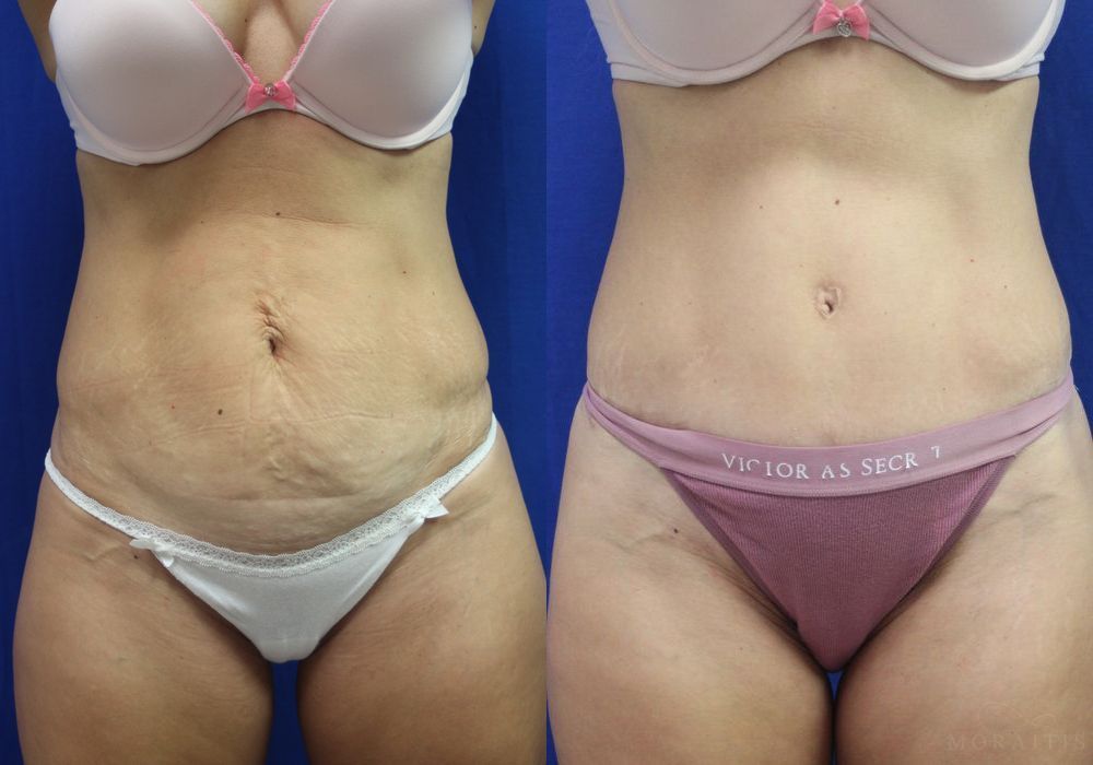Tummy Tuck - Case 15351