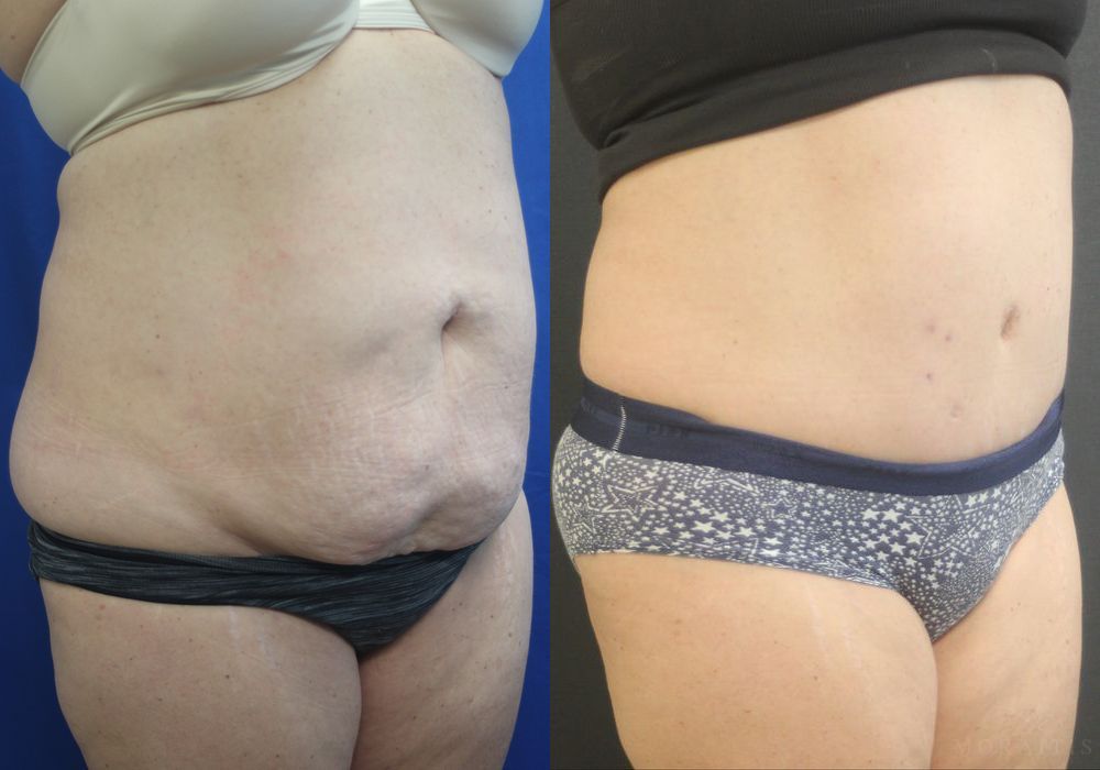 Tummy Tuck - Thumbnail 2