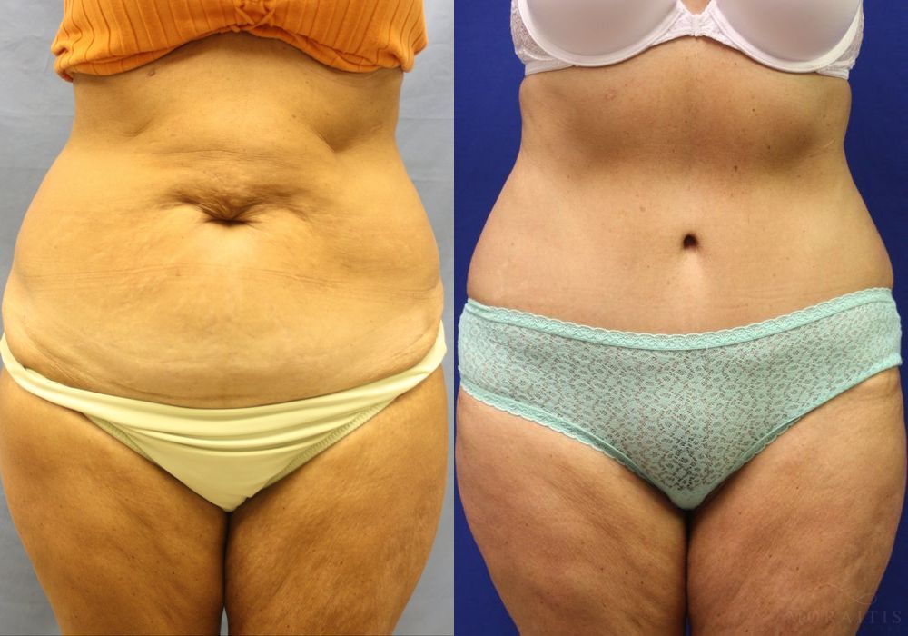 Tummy Tuck - Case 15343