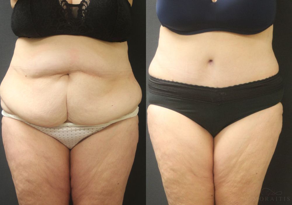 Tummy Tuck - Case 15362