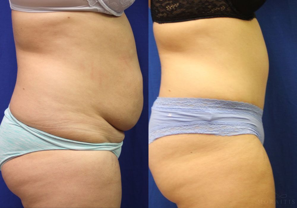 Tummy Tuck - Thumbnail 2