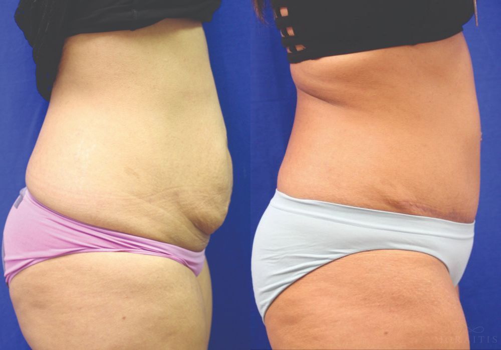 Tummy Tuck - Thumbnail 3