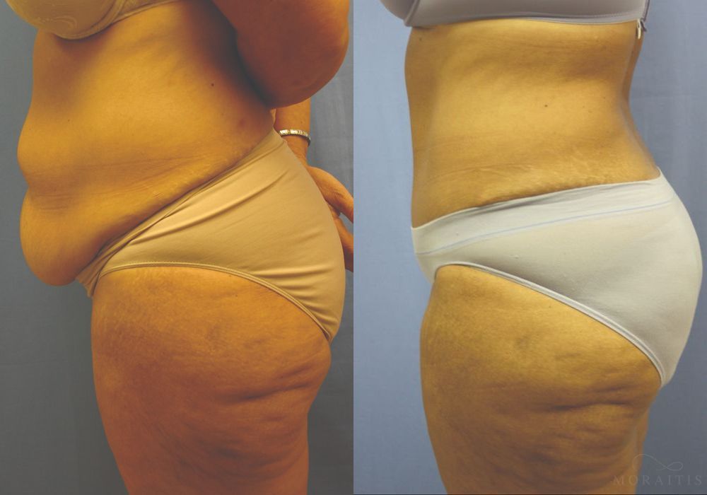 Tummy Tuck - Thumbnail 3