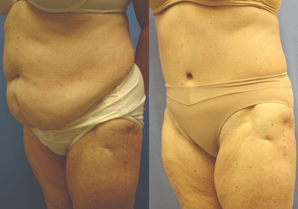 Tummy Tuck - Thumbnail 2