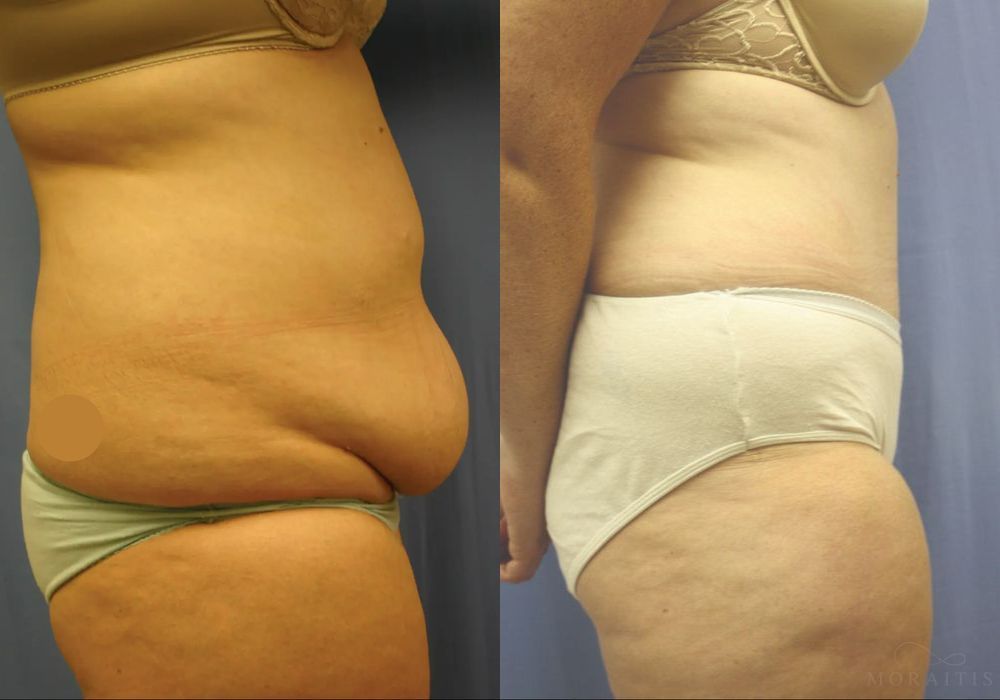 Tummy Tuck - Thumbnail 3
