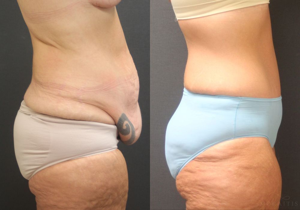 Tummy Tuck - Thumbnail 2
