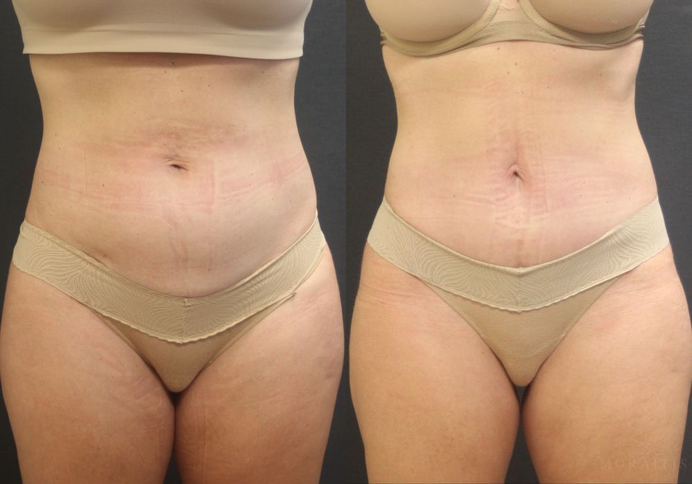 Before and after procedure result