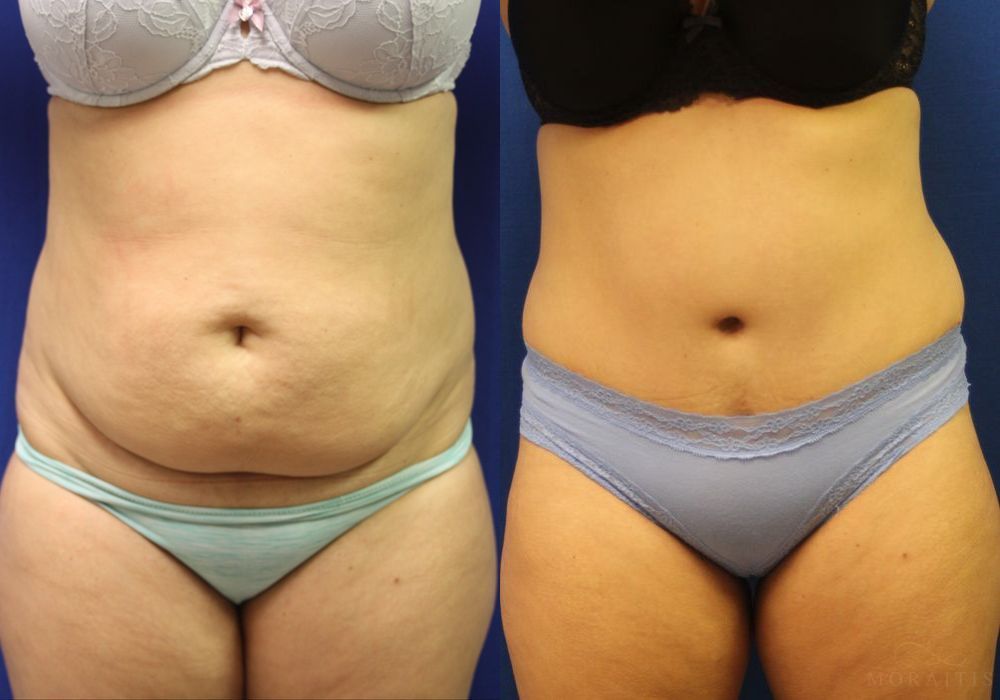Tummy Tuck - Case 15361