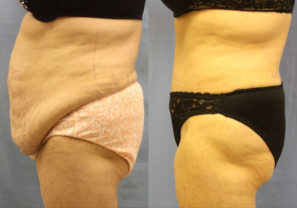 Tummy Tuck - Thumbnail 2