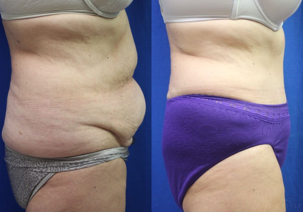 Tummy Tuck - Thumbnail 2