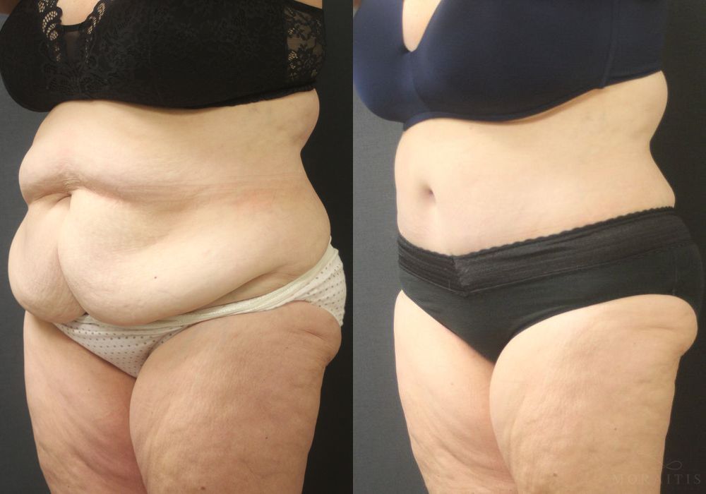 Tummy Tuck - Thumbnail 2