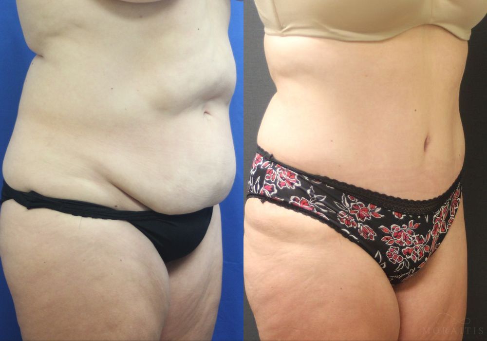 Tummy Tuck - Thumbnail 2
