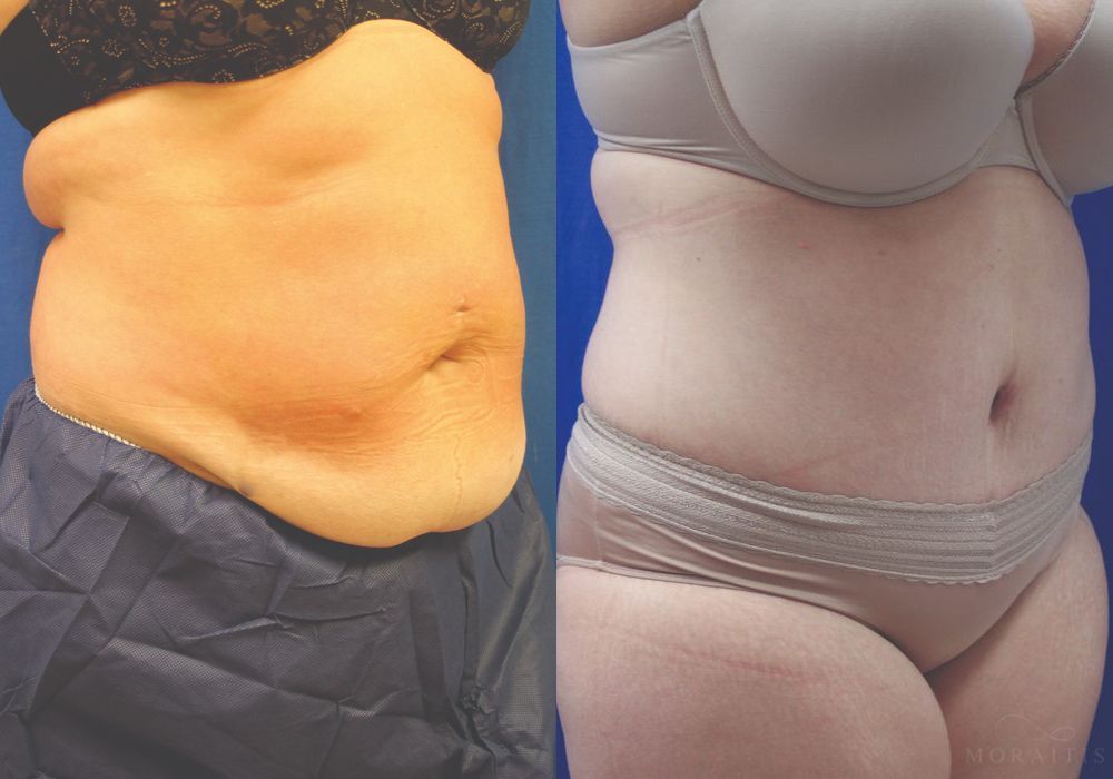 Tummy Tuck - Thumbnail 2