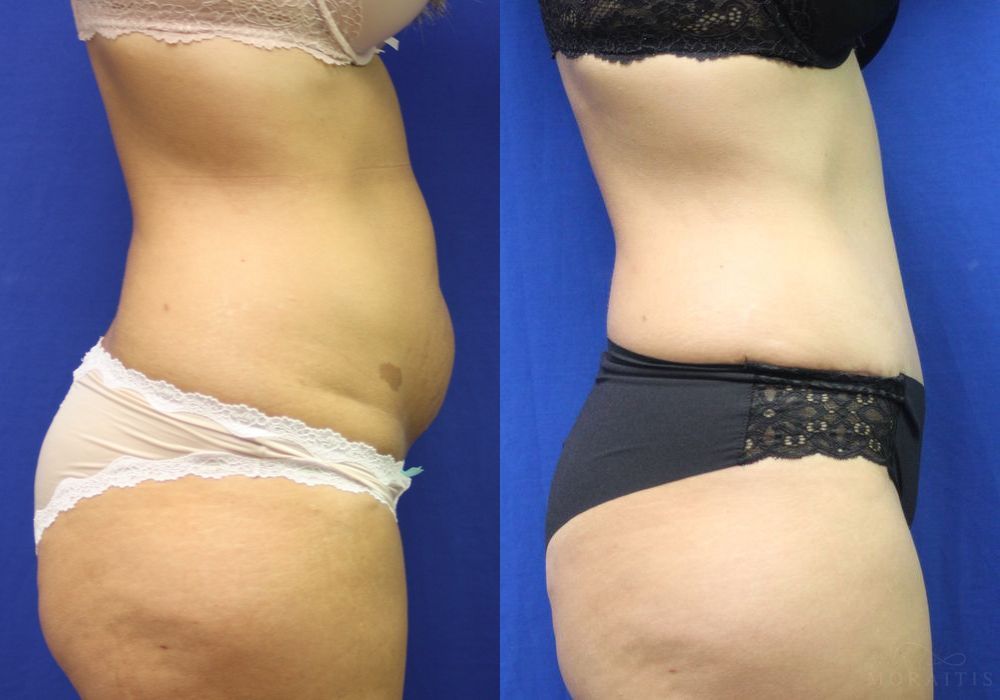 Tummy Tuck - Thumbnail 2
