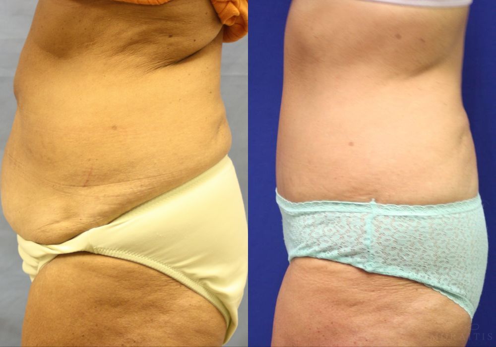 Tummy Tuck - Thumbnail 2