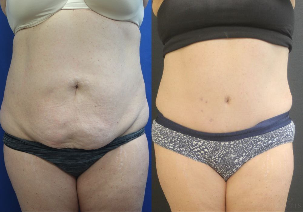 Tummy Tuck - Case 15365