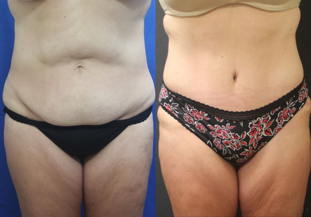 Tummy Tuck - Case 15366