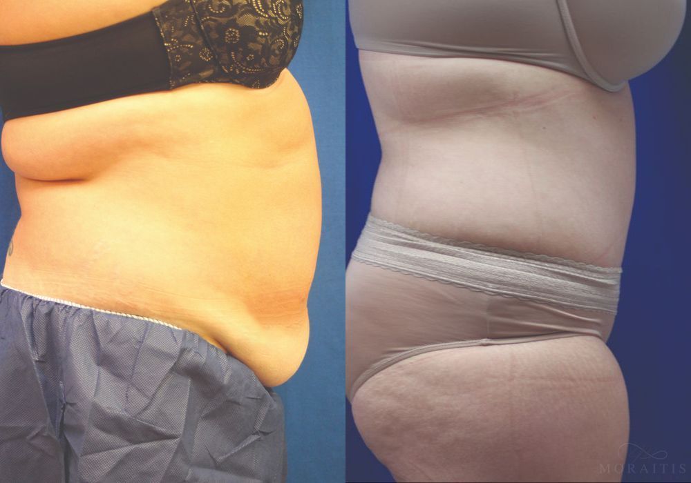 Tummy Tuck - Thumbnail 3
