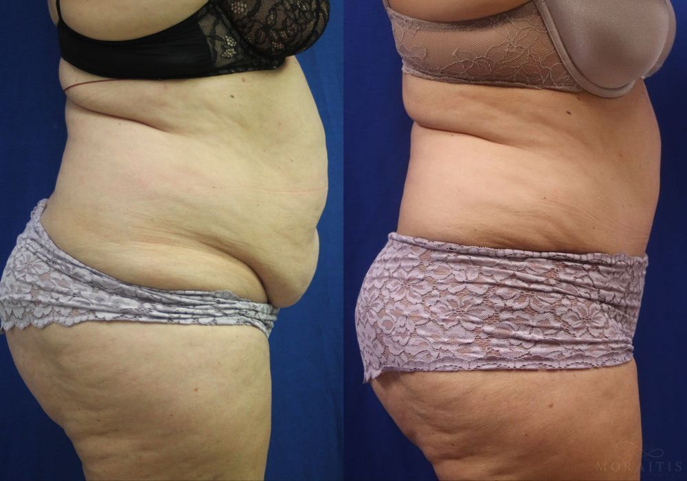 Tummy Tuck - Thumbnail 2