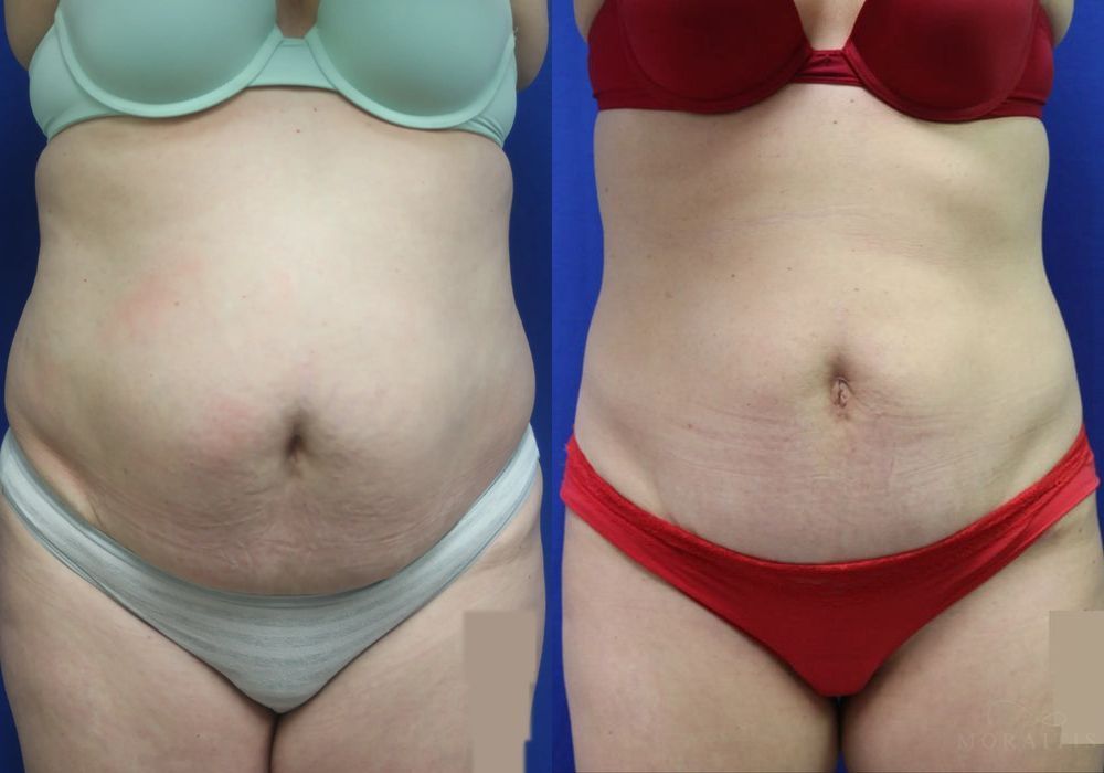 Before and after procedure result