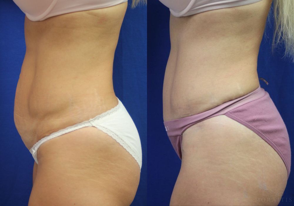 Tummy Tuck - Thumbnail 2