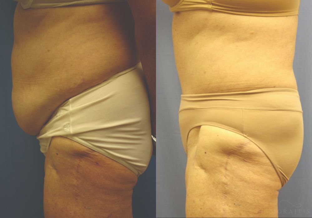 Tummy Tuck - Thumbnail 3