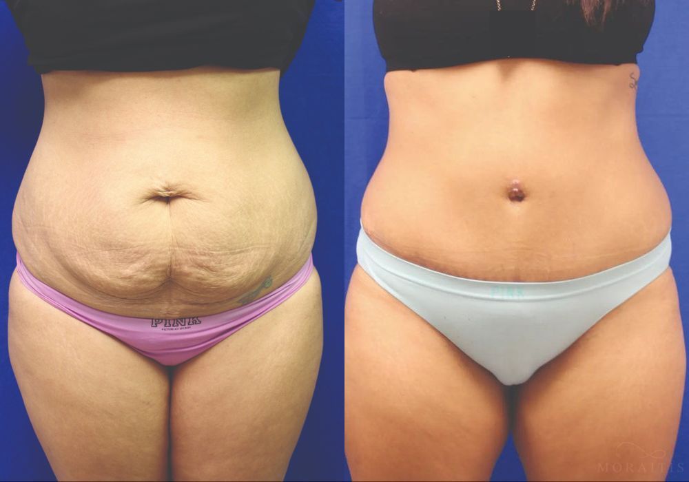 Tummy Tuck - Case 15355