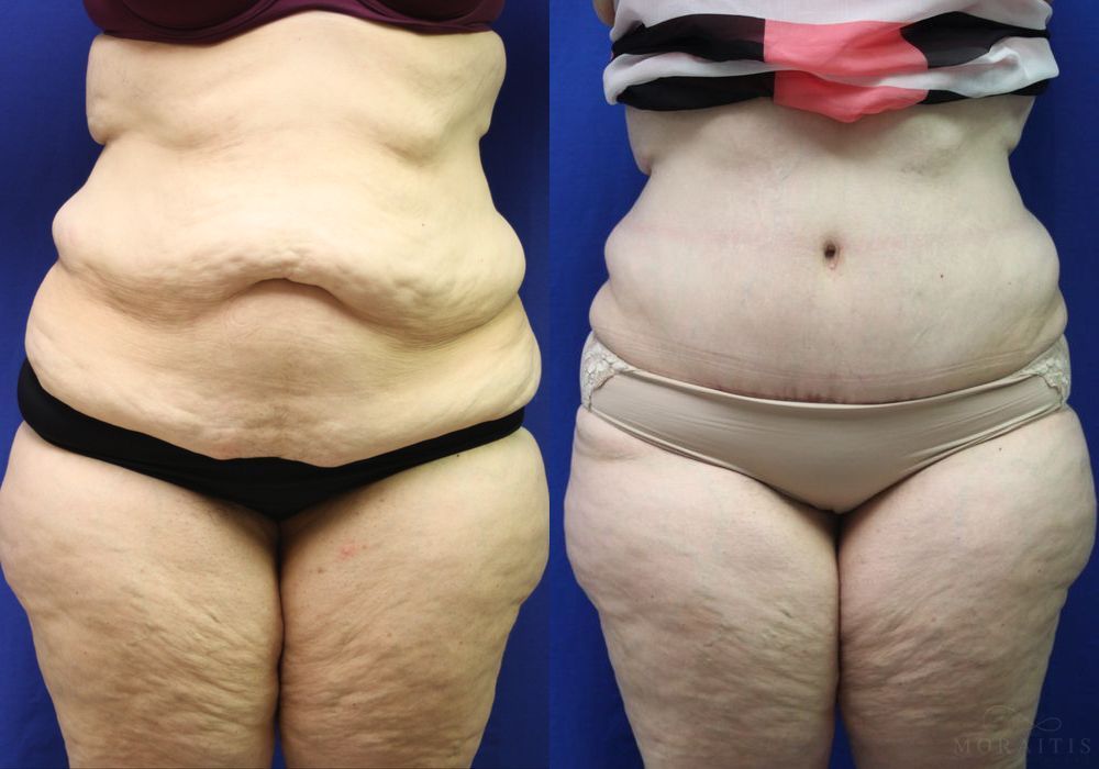 Tummy Tuck - Case 15344