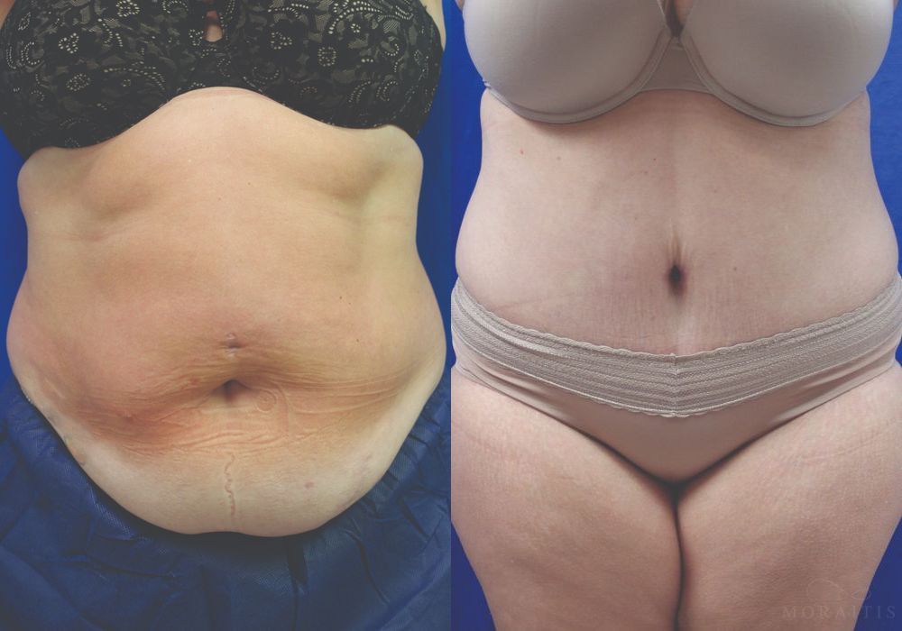 Tummy Tuck - Case 15359